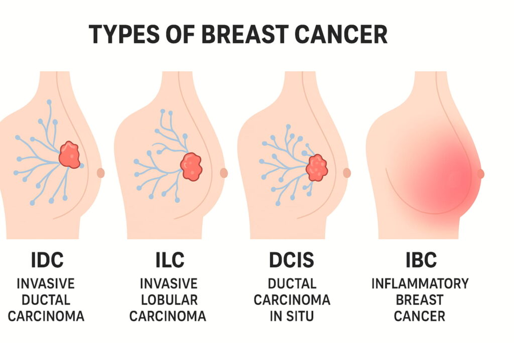 Infographic showing different types of breast cancer with labels, breast cancer 